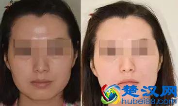 明星们都在用美白针，什么样的美白针好，效果如何？