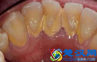 教你几个土办法，不用去医院，在家轻松解决牙结石！