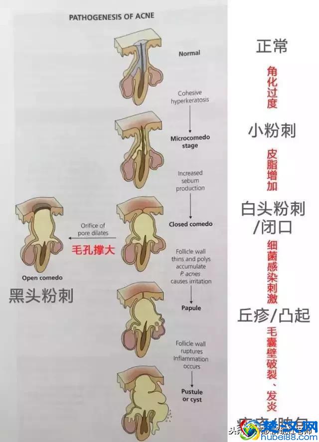 一到冬天，脸上老是冒痘痘？3个土方法，“干掉”痘痘