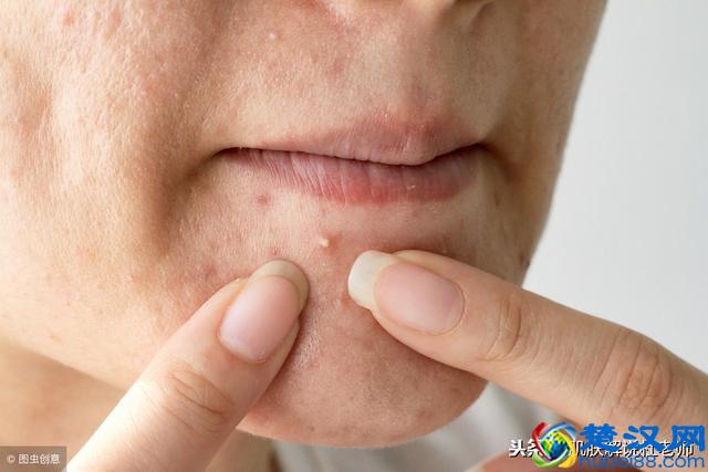 一到冬天，脸上老是冒痘痘？3个土方法，“干掉”痘痘