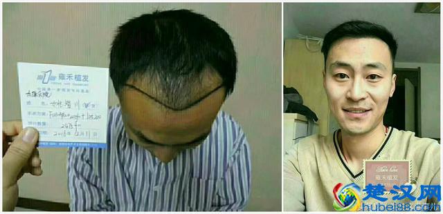 原来脂溢性脱发可以这么治，很多发友都收藏了！