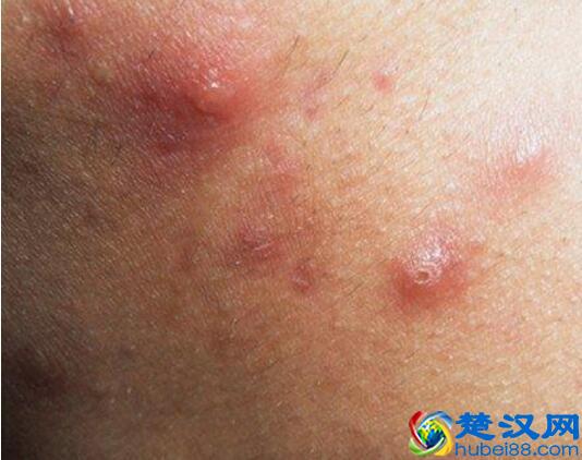 如何彻底去痤疮 正确使用这7种方法有效清除痤疮