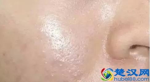 如何彻底去痤疮 正确使用这7种方法有效清除痤疮