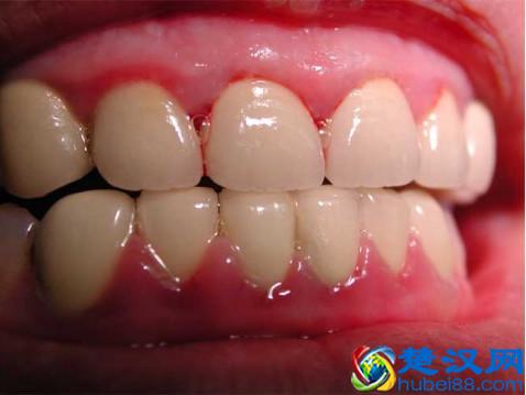 牙龈肿痛，如何快速消肿？