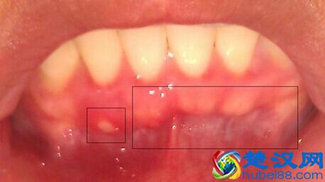 牙龈肿痛，如何快速消肿？
