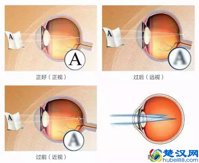 8大近视常见问题，全球父母都在关注，收藏起来吧