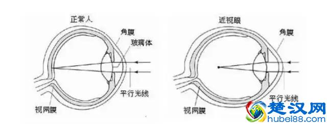 8大近视常见问题，全球父母都在关注，收藏起来吧