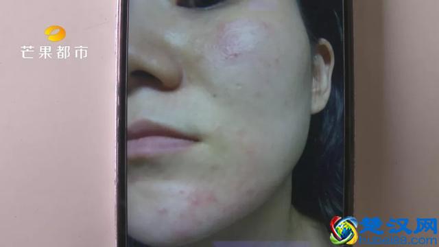 恐怖！长沙一女孩使用“苗方清颜”后，脸差点……