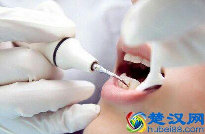 花200元洗一次牙，到底值不值？牙医告诉你真相