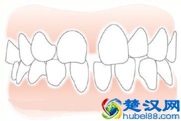 牙列稀疏怎么办？这些问题你要知道！