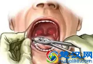 拔牙 | 下颌阻生牙拔除术图解