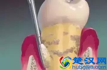 拔牙 | 下颌阻生牙拔除术图解