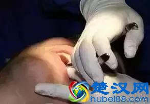 拔牙 | 下颌阻生牙拔除术图解