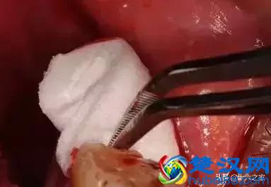 拔牙 | 下颌阻生牙拔除术图解