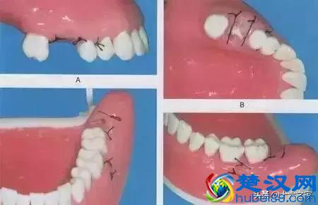 拔牙 | 下颌阻生牙拔除术图解