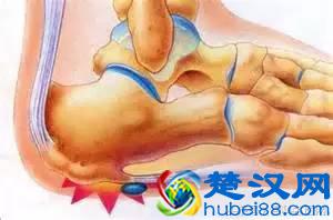 脚后跟疼痛，不红不肿是怎么回事？原因有哪些？