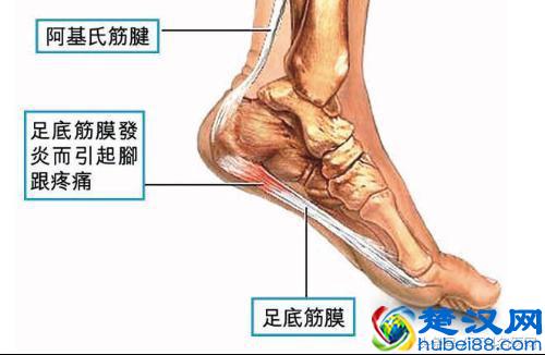 脚后跟疼痛，不红不肿是怎么回事？原因有哪些？