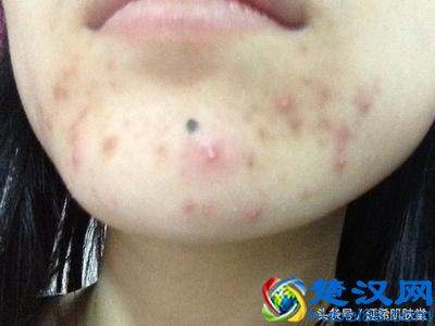 中药方：为什么下巴总是长痘？专家告诉你身体是哪里出了问题！