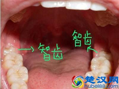 为什么有人长智齿？而有人却从来不会长？