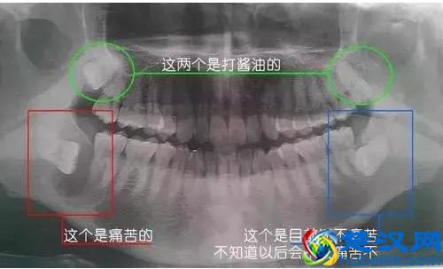 为什么有人长智齿？而有人却从来不会长？