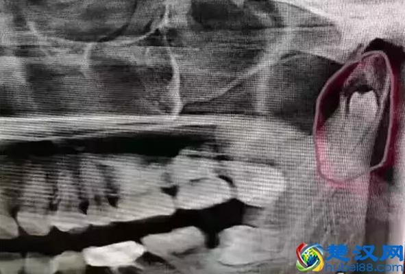 为什么有人长智齿？而有人却从来不会长？