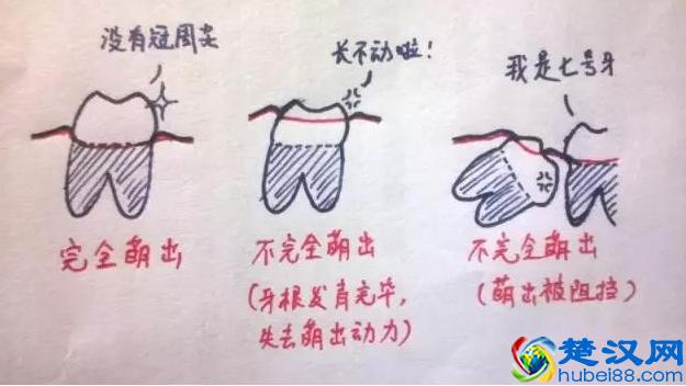 为什么有人长智齿？而有人却从来不会长？