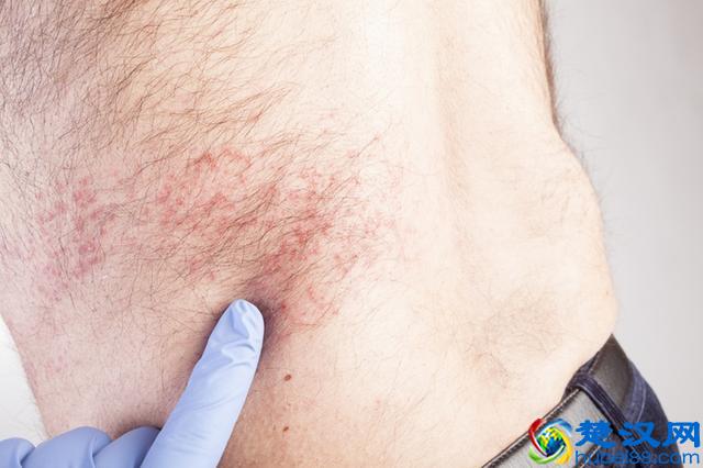 慢性湿疹纠缠他近十年！中医教你应该这么治
