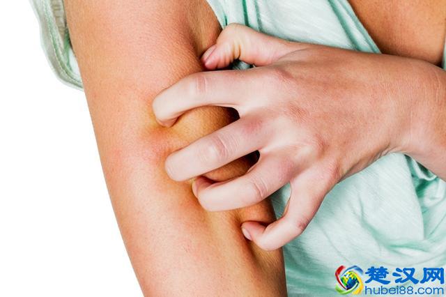 慢性湿疹纠缠他近十年！中医教你应该这么治