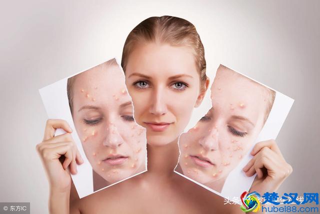 长了脂肪粒怎么办？教你一些小方法，就能轻松去除