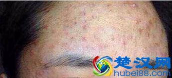 额头上长痘痘是什么原因？如何处理？