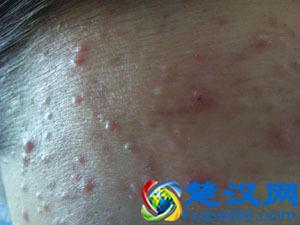 额头上长痘痘是什么原因？如何处理？