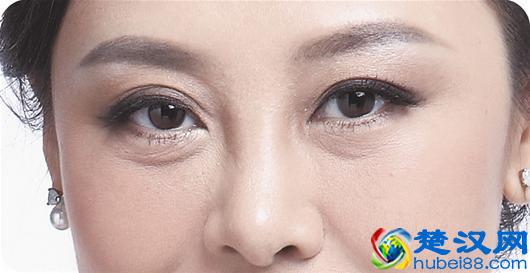 如何去眼角纹 做好这几步打造无暇眼周