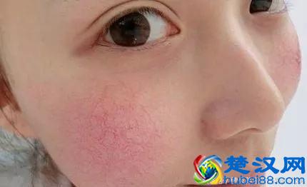 红脸蛋不是病，教你一招正确安全消除面部红血丝