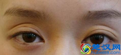 眼窝凹陷怎么办？这样做，眼睛瞬间电力十足