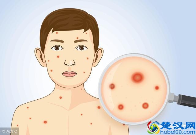 患水痘期间，饮食上有什么禁忌？这3个小要点都得牢记