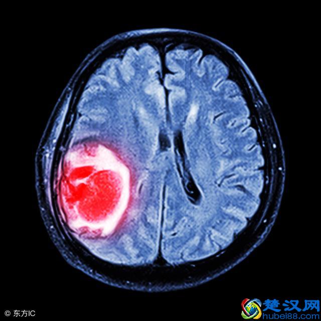 辟谣！磁共振检查一定比CT好吗？其实，磁共振也有缺点