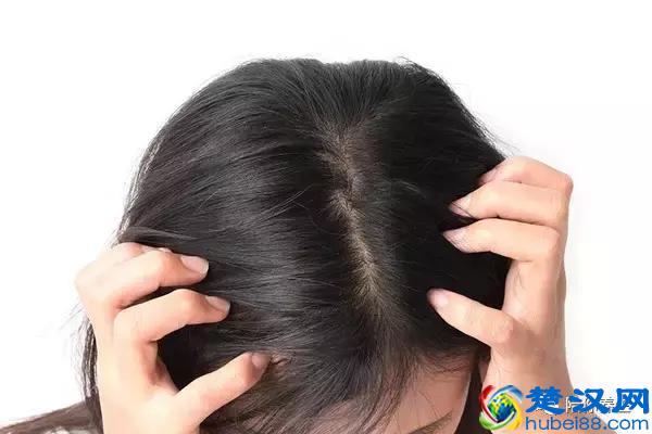 头皮上长痘痘是什么原因 了解起因才能有效治疗