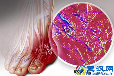 得了痛风怎么办？该吃什么药？如何预防痛风发作？