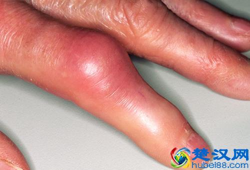 得了痛风怎么办？该吃什么药？如何预防痛风发作？