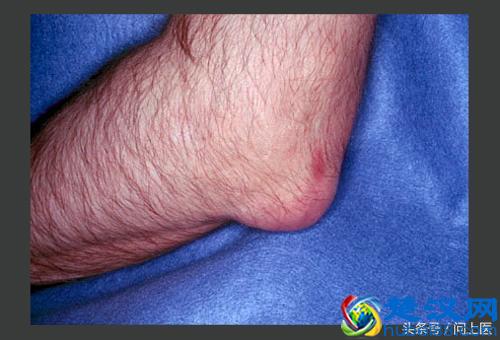 得了痛风怎么办？该吃什么药？如何预防痛风发作？