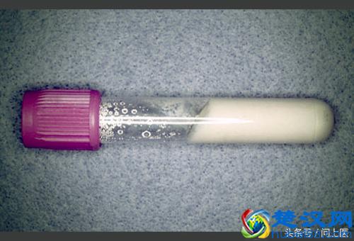 得了痛风怎么办？该吃什么药？如何预防痛风发作？