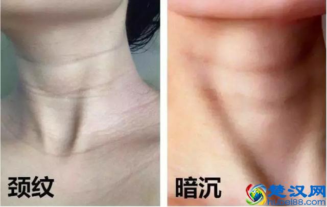 20岁就有颈纹？想要去掉颈纹只用颈霜做不到！