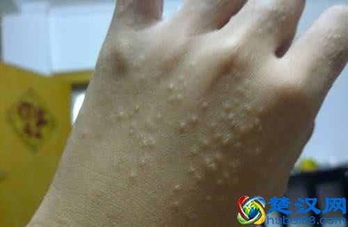 夏天出汗后，手脚出现水泡是怎么回事？