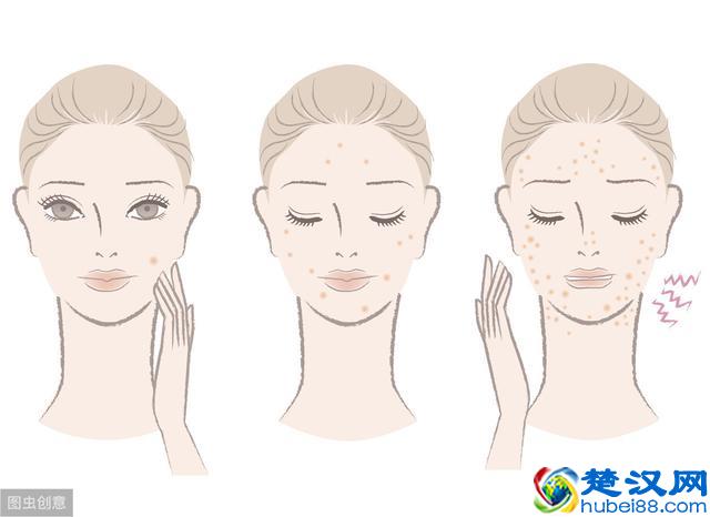 那么多祛痘产品，最有效最好用的竟然是最便宜的它