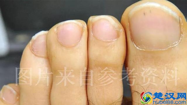 重口味预警：原来尸斑居然有这么多颜色