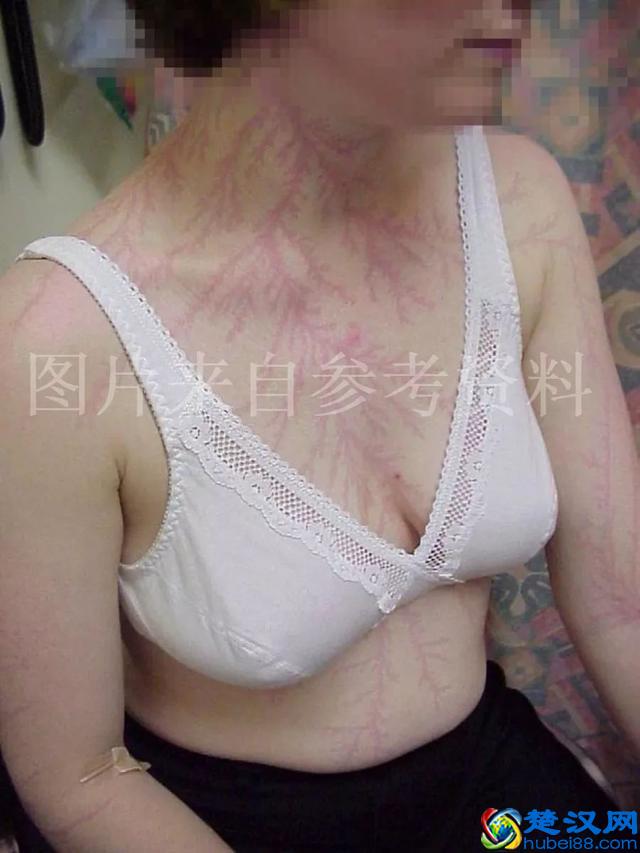 重口味预警：原来尸斑居然有这么多颜色