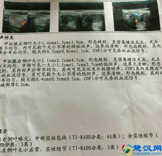 甲状腺超声报告「TI-RADS」级别越高，结节越有可能是恶性！