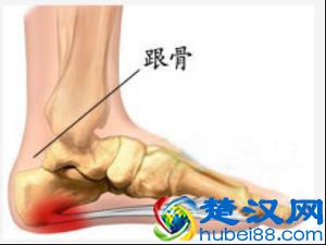 脚后跟疼是什么原因 脚后跟疼是怎么回事 脚后跟痛怎么治疗好