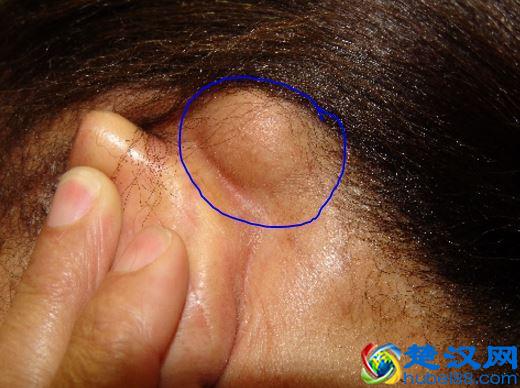 皮肤科医生：耳朵后面长了疙瘩，4个原因别忽视！