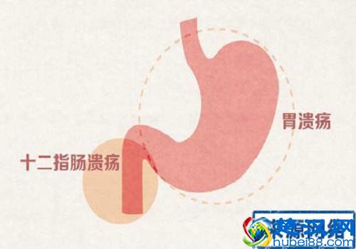 十二指肠溃疡患者要注意这几点，这些食物可以别吃